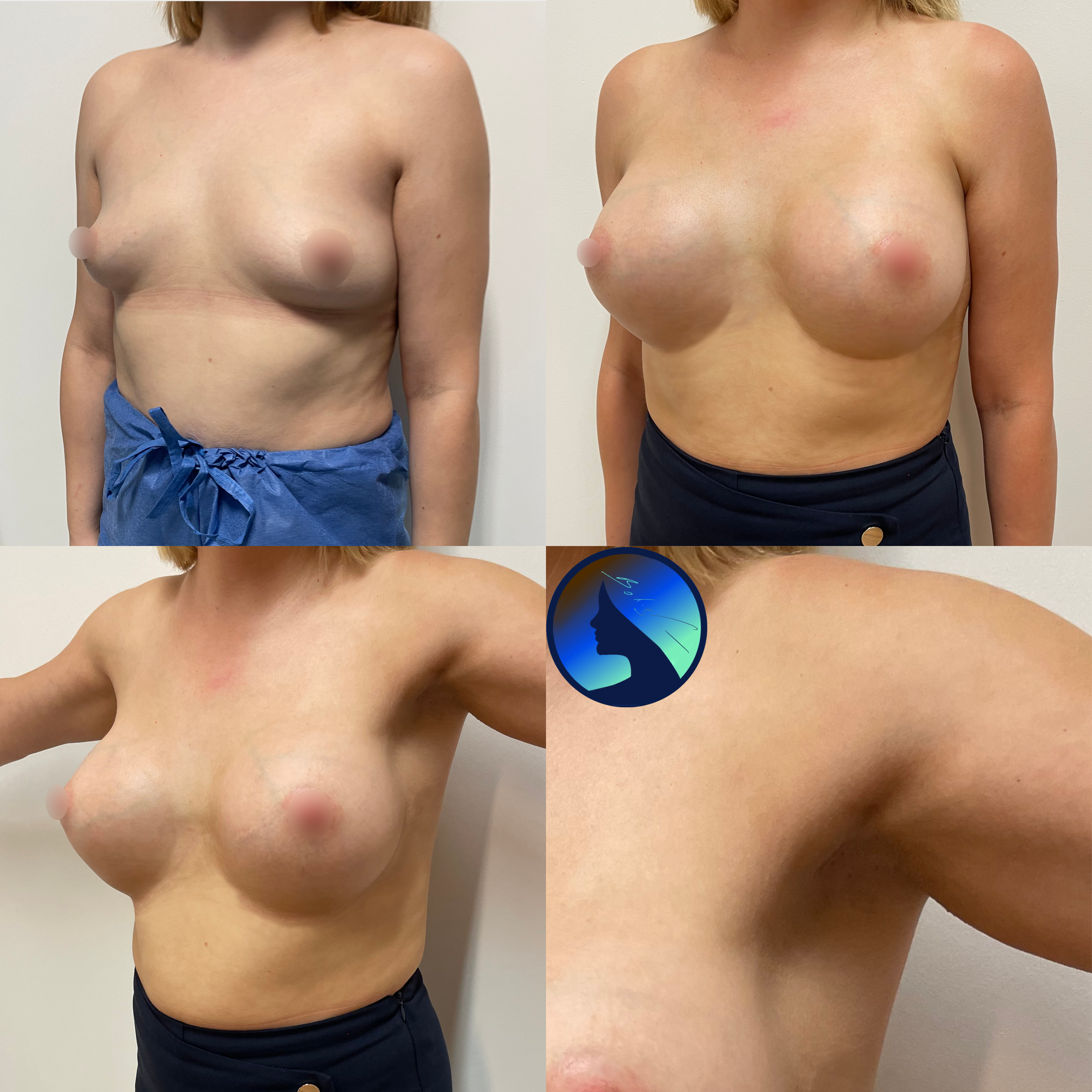 different arm positions transaxillary scar