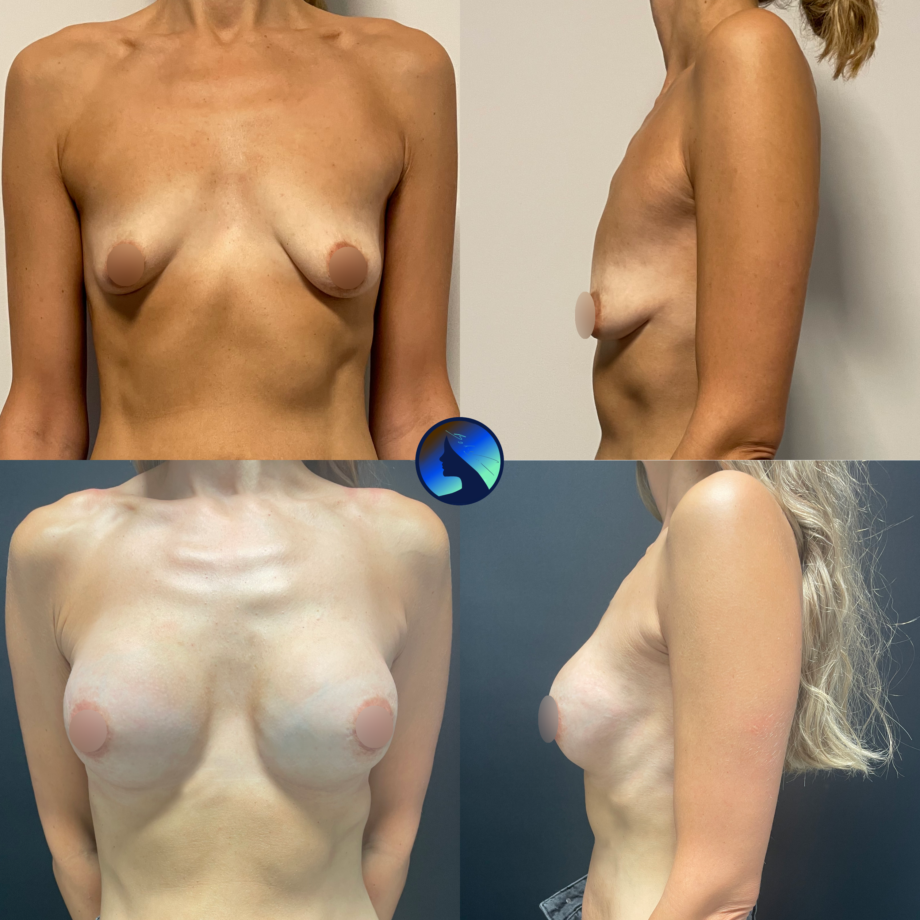 endoscopic tuberous breast augmentation