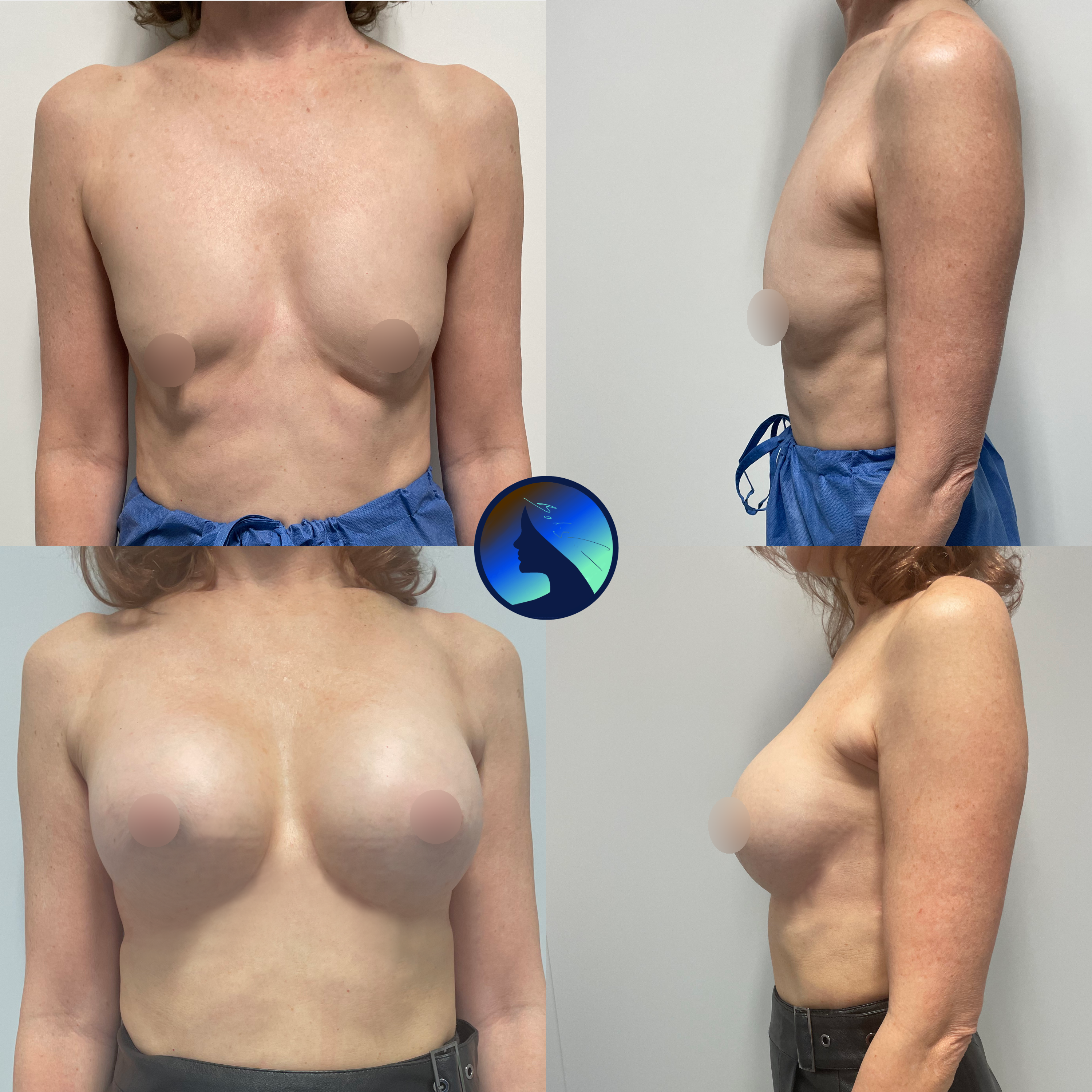 Endoskopowe powiększenie piersi