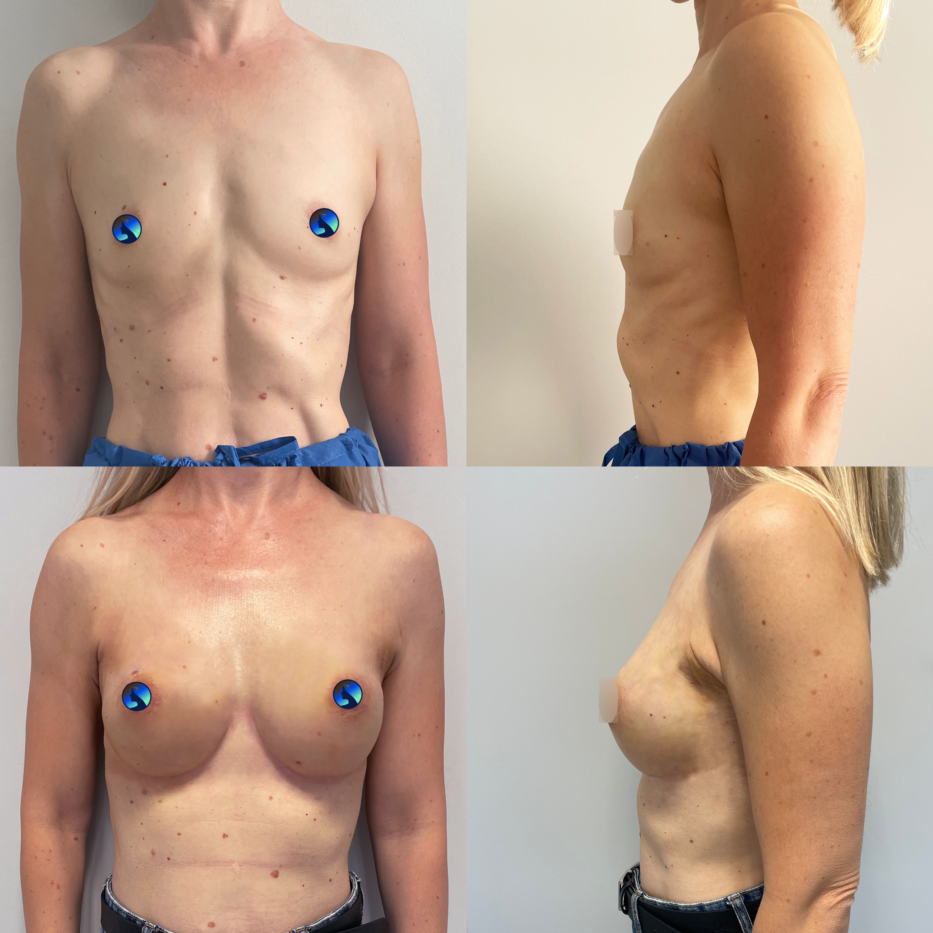 first in poland endoscopic mastectomy
