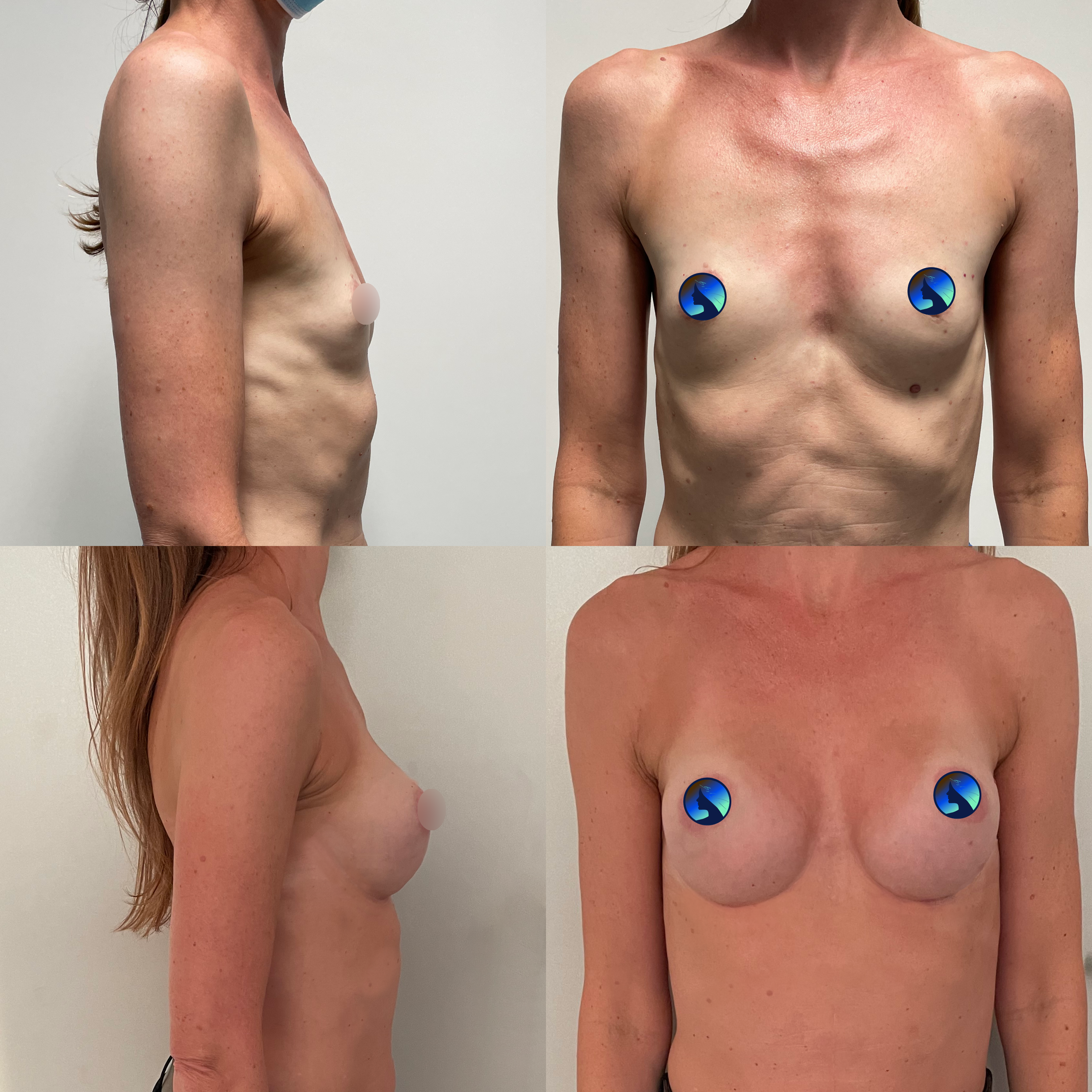 końcowy efekt implanty endoskopowo