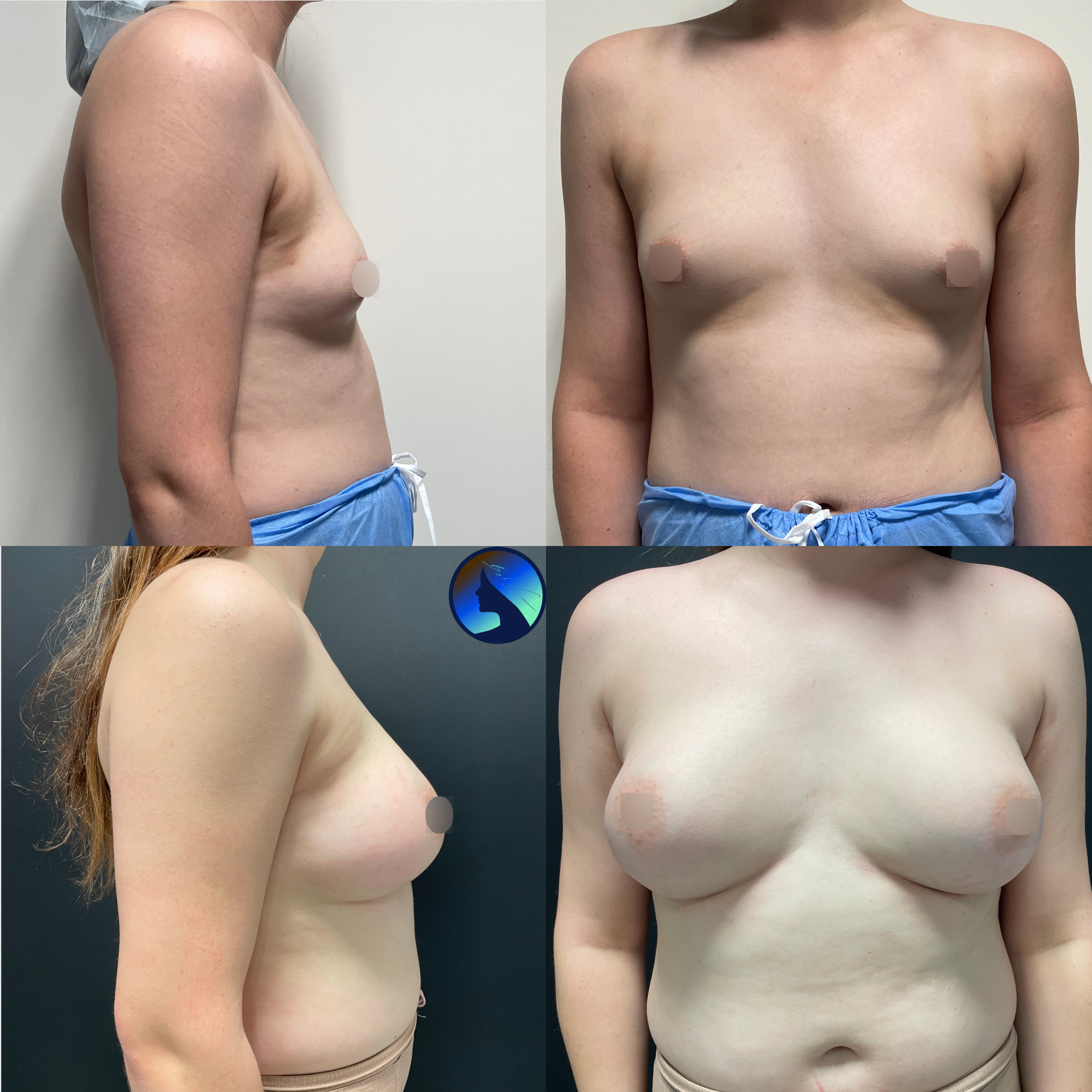 powiększenie piersi trans