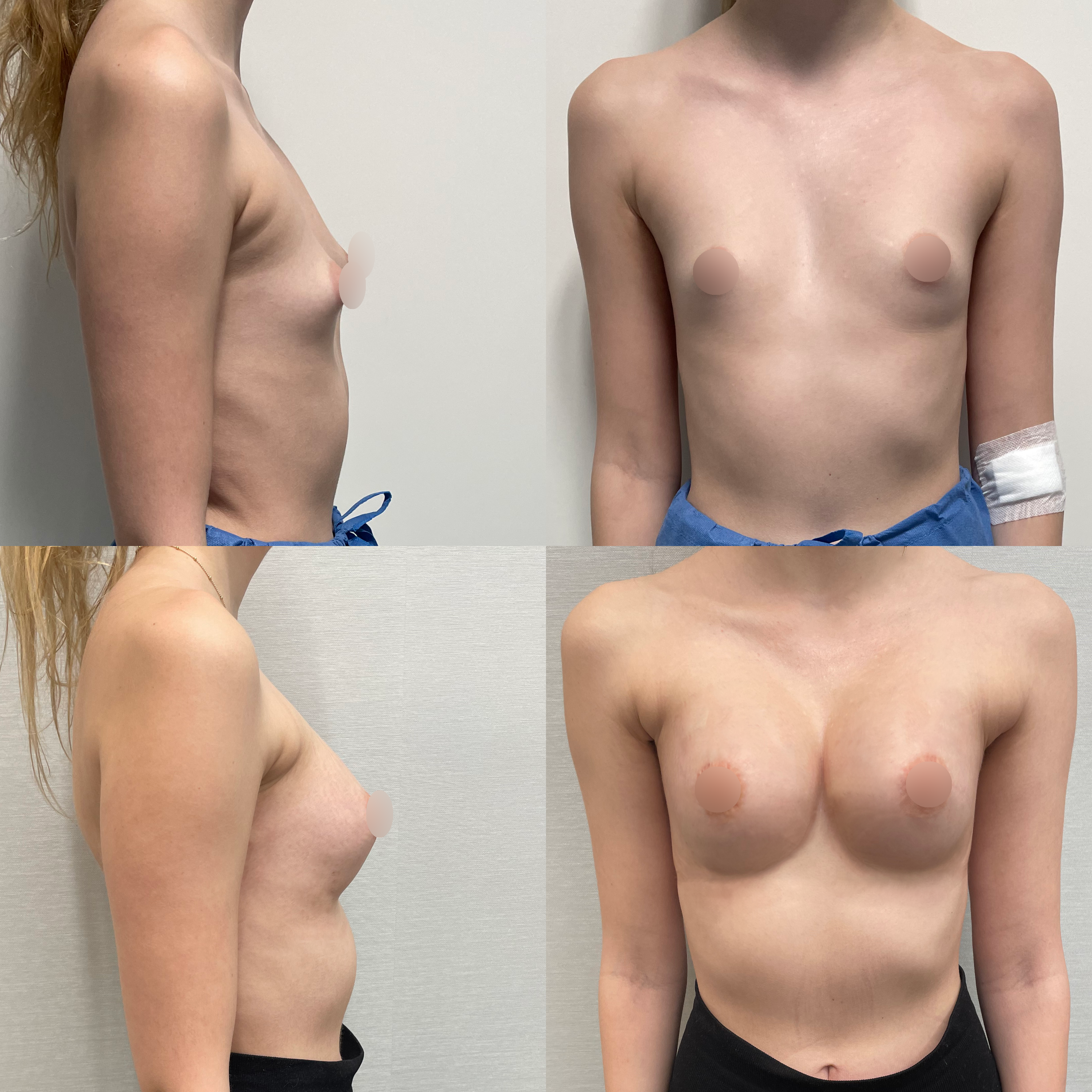 symetryzacja piersi przez pachę