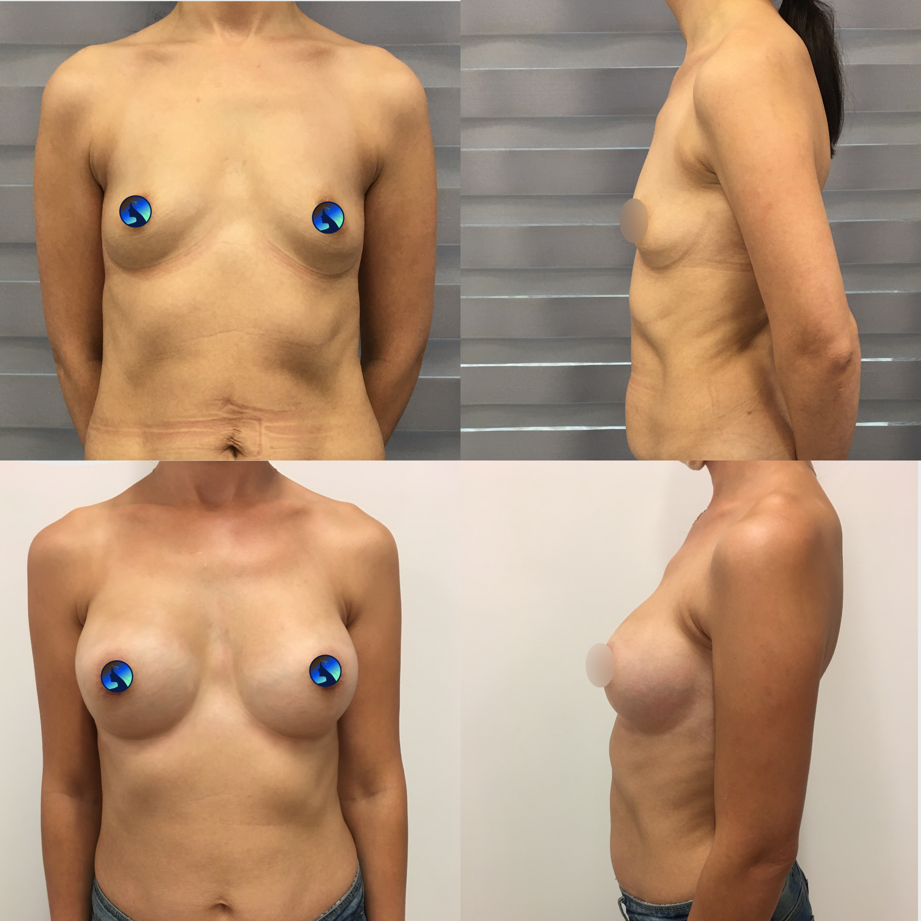 transaxillary breast augmentation after many years