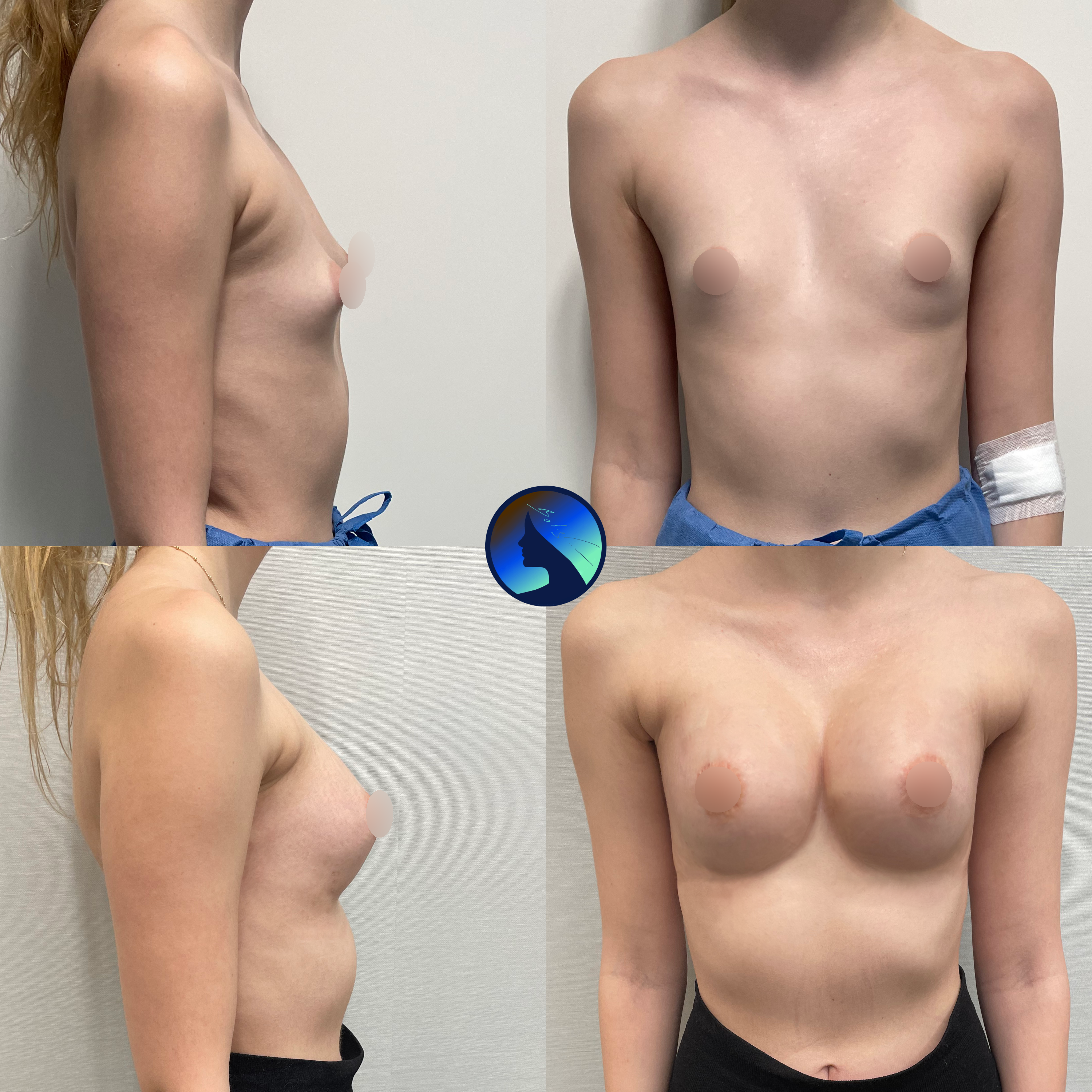 transaxillary breast symmetrization
