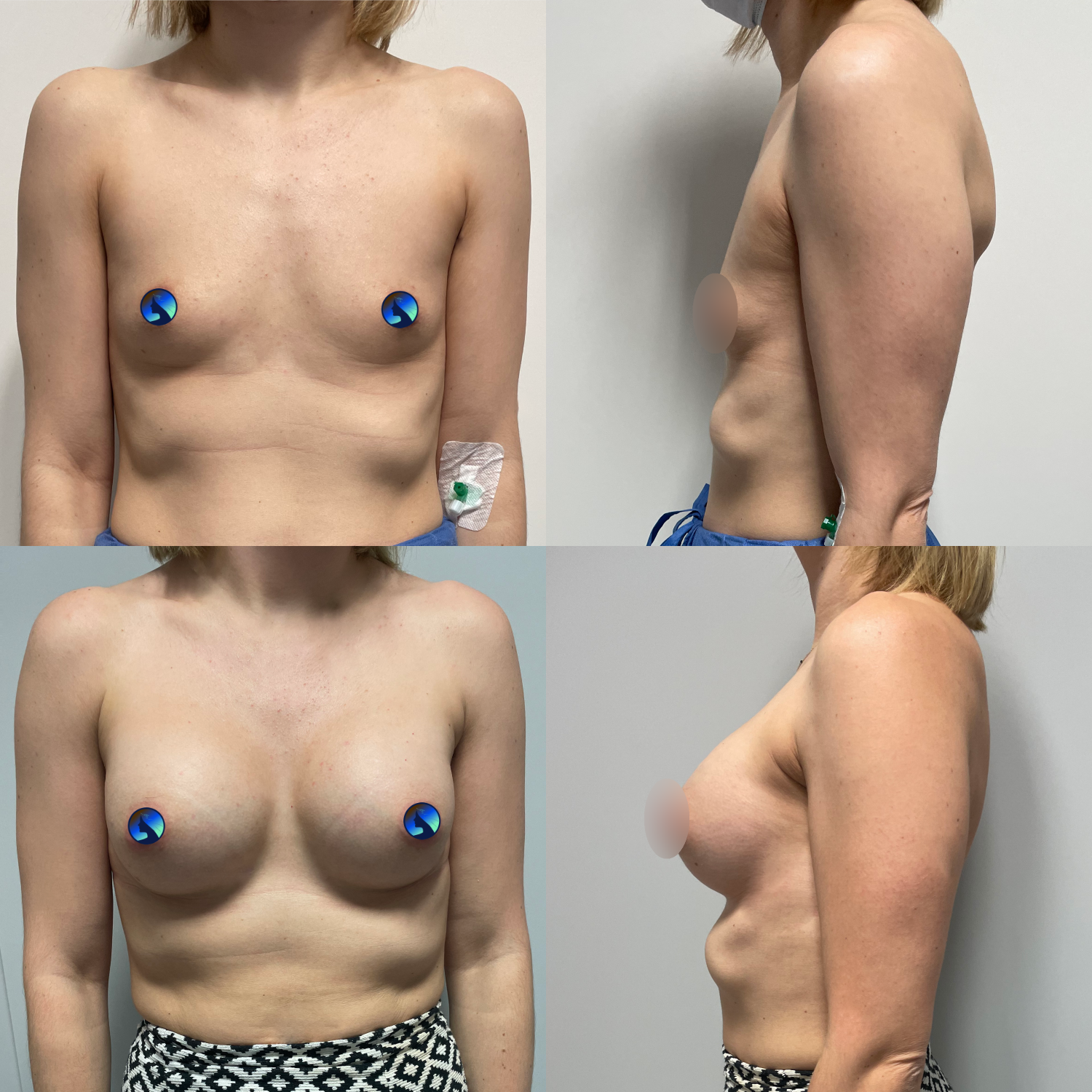 transaxillary mentor implants