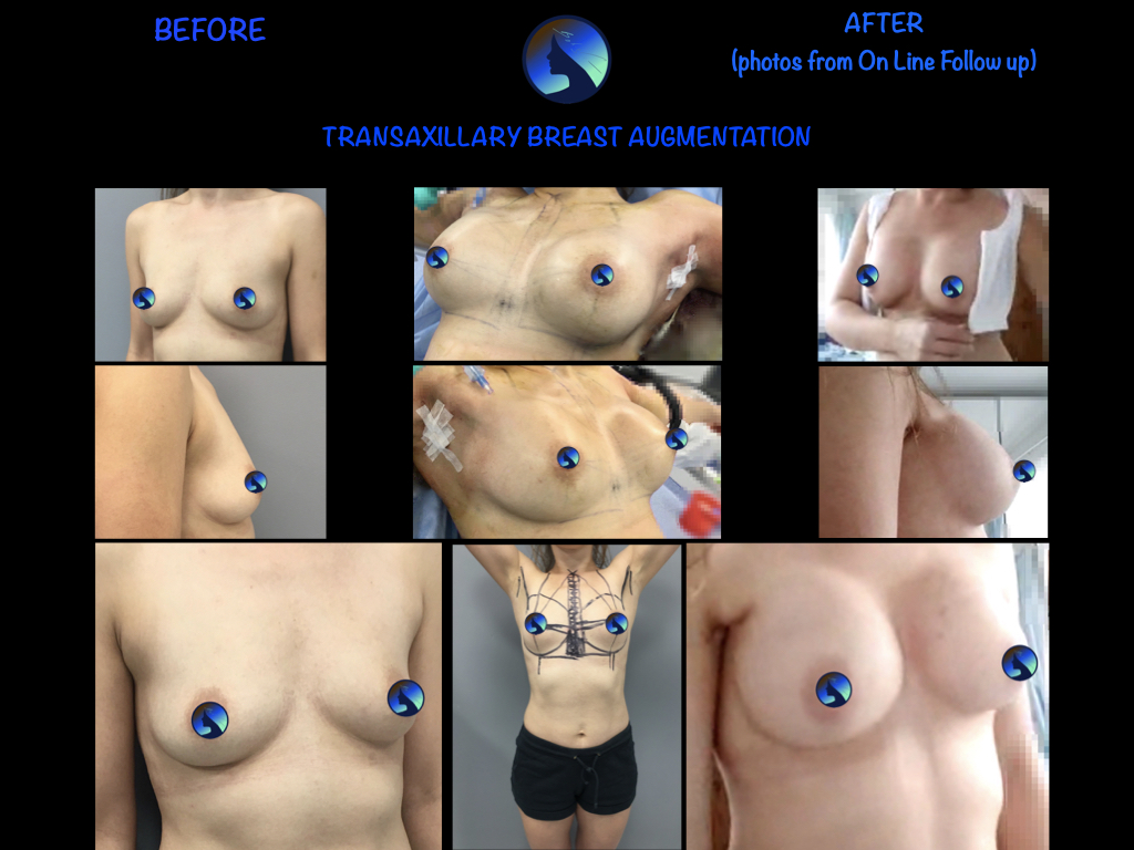 Transaxillary Thin Tall Patient