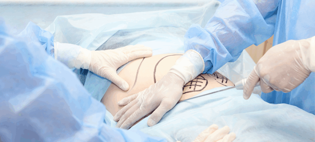 Liposukcja policzków