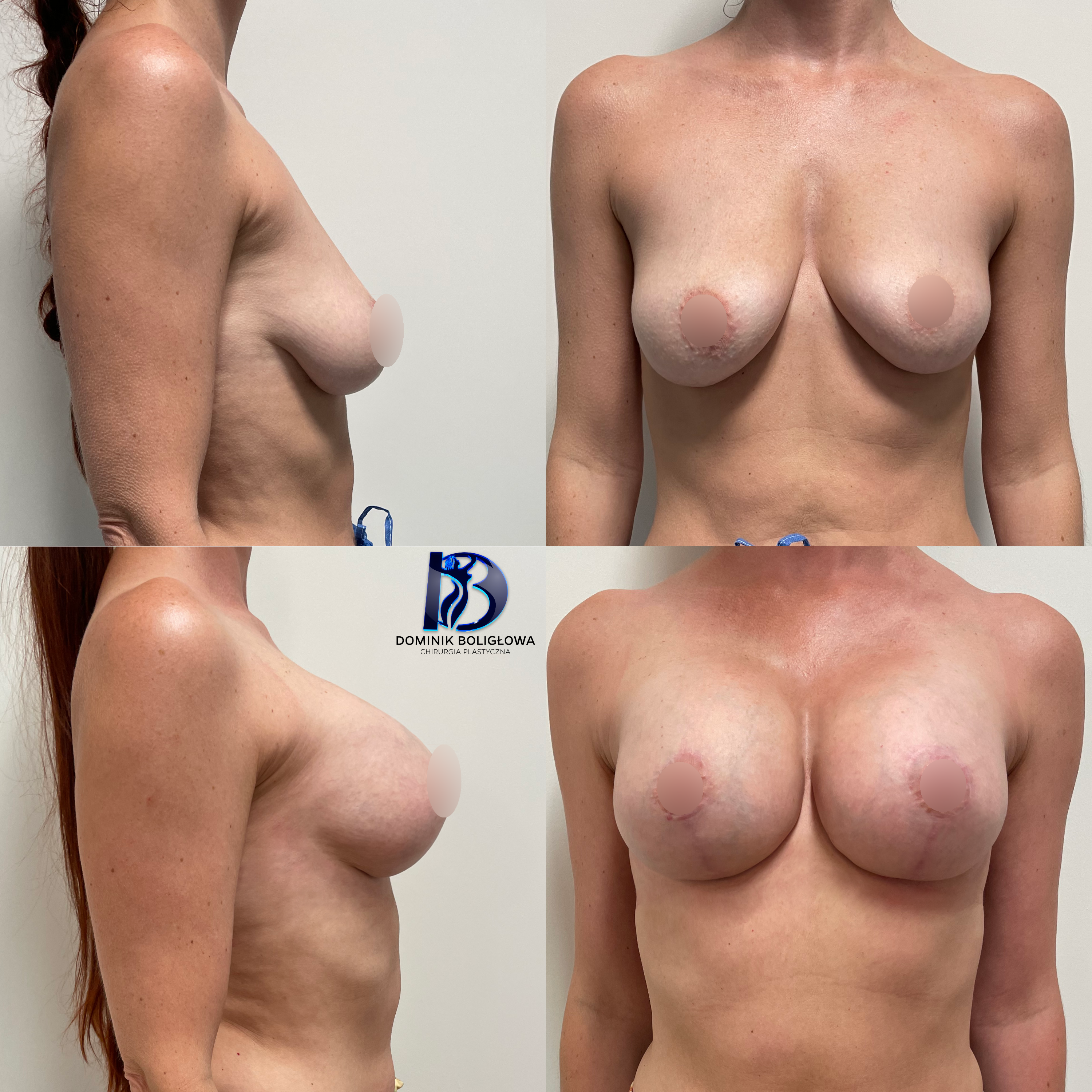 Powiększenie z podniesieniem nowe