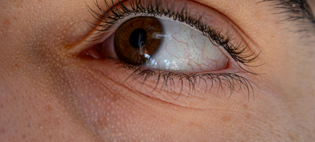 Podpuchnięte powieki przyczyny i leczenie